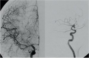 Chru De Tours Neuro Radiologie Interventionnelle Art Riographie