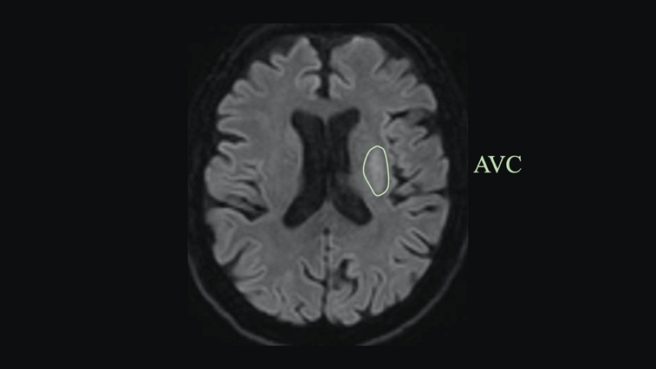 Chru De Tours Neuro Radiologie Interventionnelle L Avc