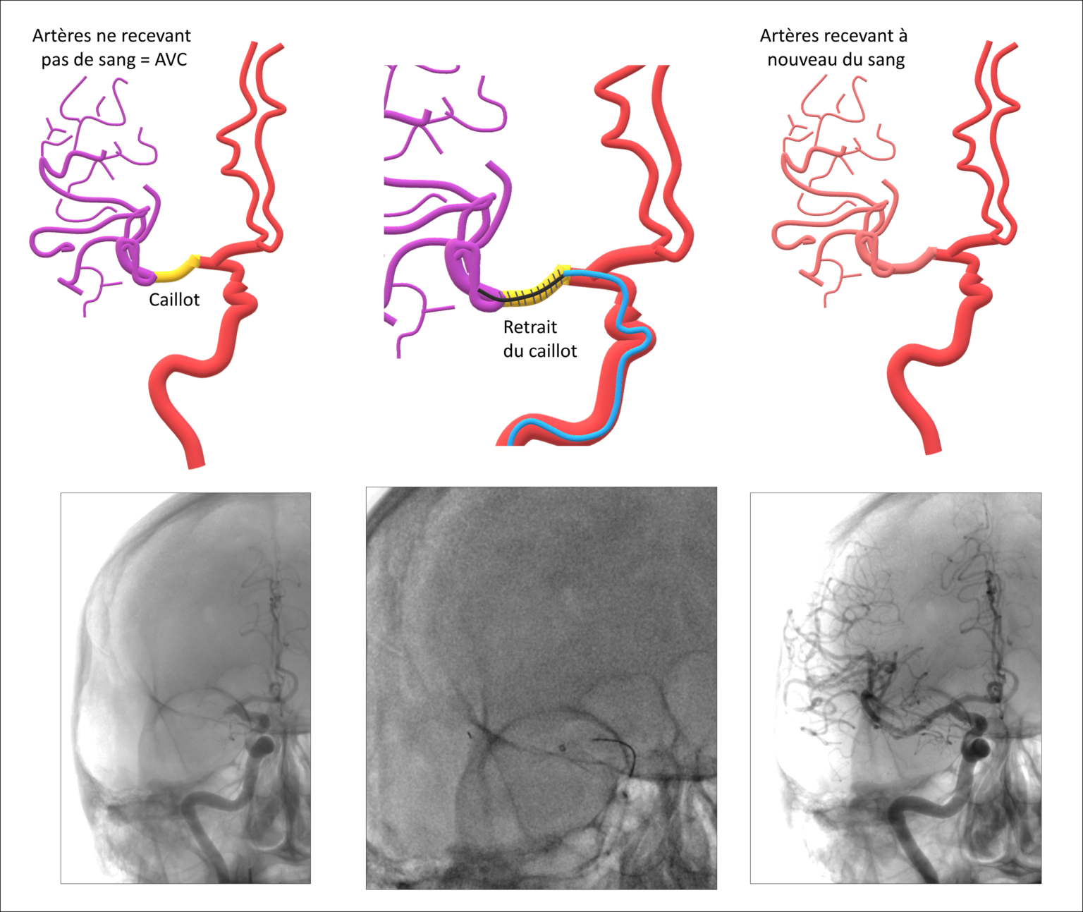 Chru De Tours Neuro Radiologie Interventionnelle L Avc