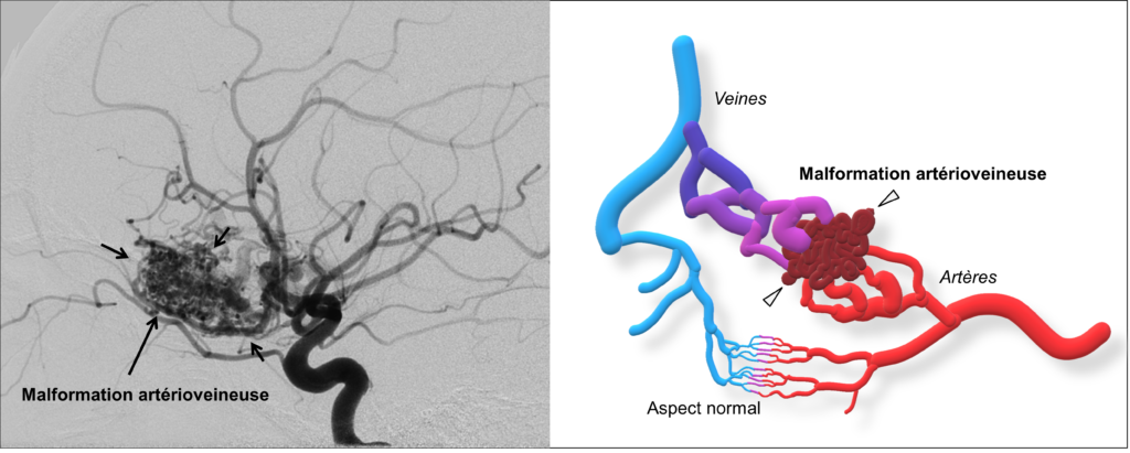 Chru De Tours Neuro Radiologie Interventionnelle Malformation Art Rio Veineuse C R Brale