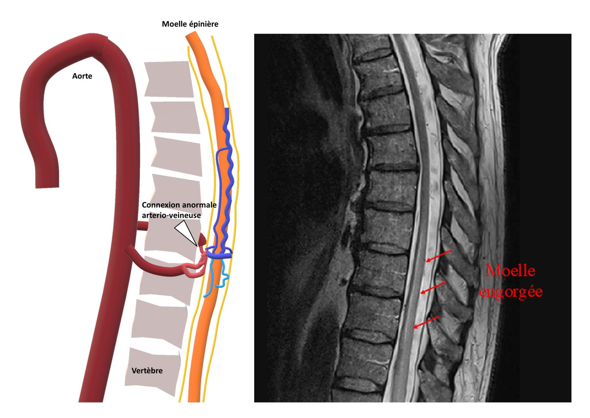 CHRU de Tours. Neuro-Radiologie Interventionnelle. Lésions vasculaires ...